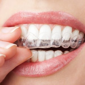 clearcorrect aligners