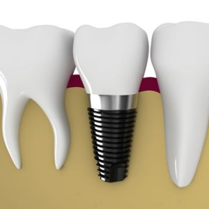 hamilton-dental-care-implants