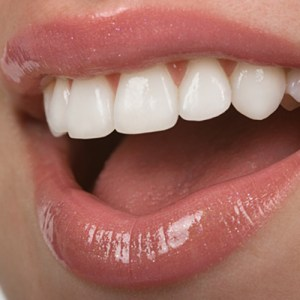 hamilton-dental-care-veneers