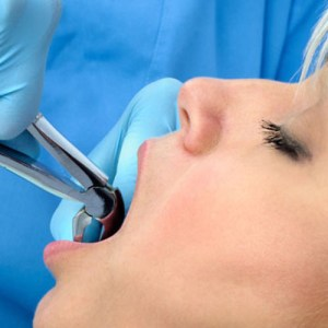 hamilton-dental-extractions